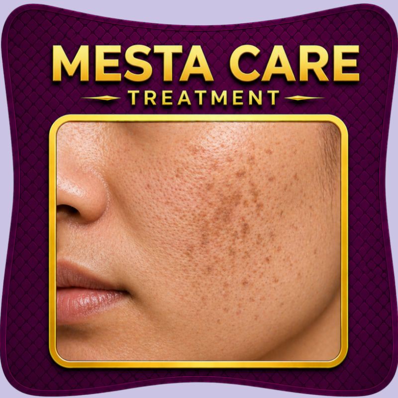 Mesta melasma treatment skincare solution