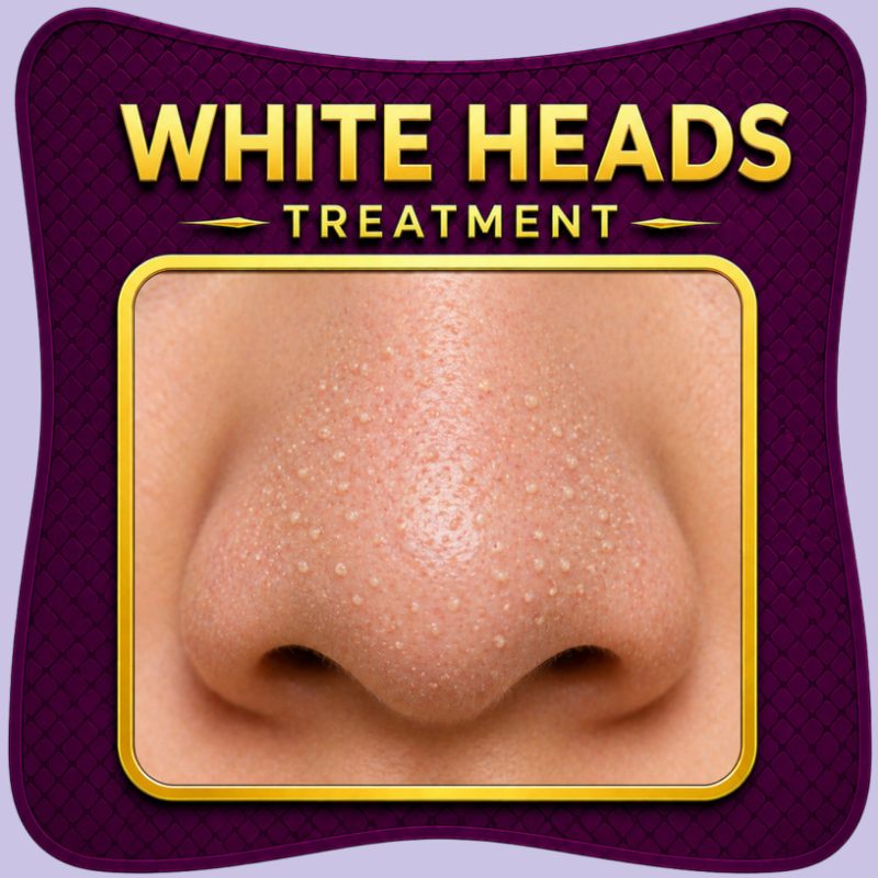 Whitehead treatment clear pores skincare